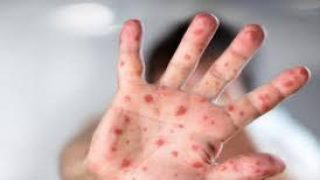 120 وفاة و25 ألف إصابة.. مسؤول: الحصبة في المغرب أصبحت وباء