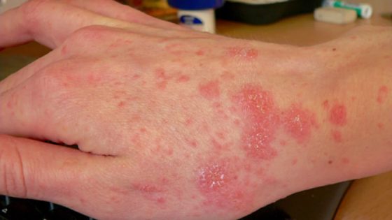 عاجل: اشتباه في حالات “الجرب” بإعدادية دراسة ورياضة مولاي رشيد بطنجة… ما الاحتياطات الواجب اتخاذها؟